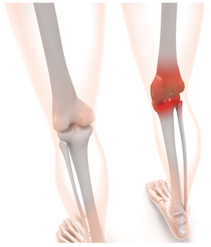 膝痛の時に膝周囲筋の緊張が強くなるのはなぜ？